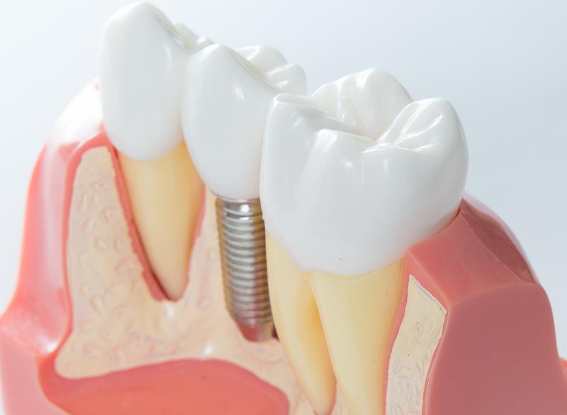 Implanturi dentare sau punți dentare?