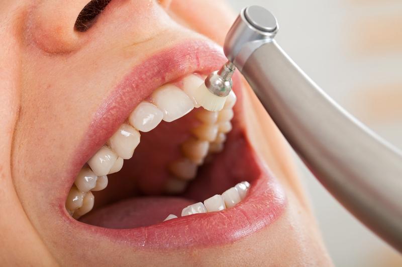 Ce este și cum ne ajută detartrajul dentar?